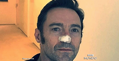 Qué es el carcinoma basocelular, el cáncer de piel que sufre el actor Hugh Jackman